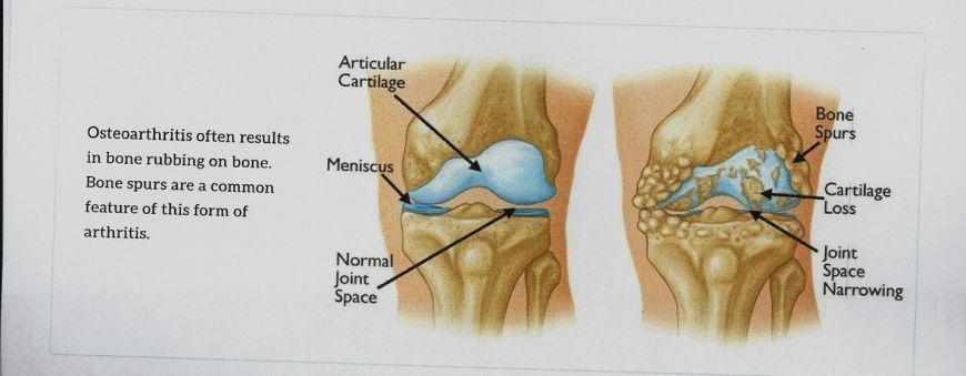 Arthritis of the Knee: Symptoms, Non-Surgical and Surgical Treatment in Dubai Arthritis of the Knee: Symptoms, Non-Surgical and Surgical Treatment in Dubai